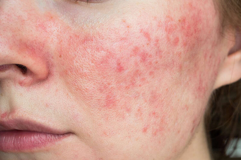 Äkillinen allerginen reaktio kasvoissa