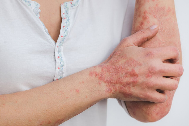 Psoriasis vai atooppinen ihottuma – kuinka erottaa ja hoitaa oikein?
